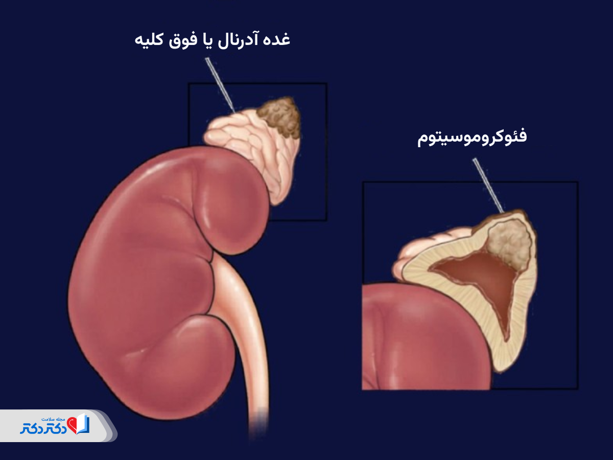 بیماری فئوکروموسیتوم چیست؟
