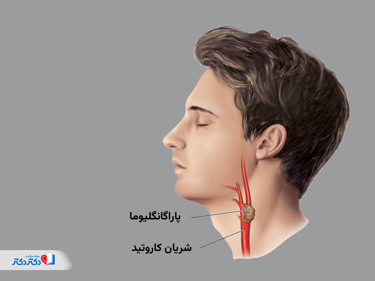 بیماری فئوکروموسیتوم خارج از غده آدرنال