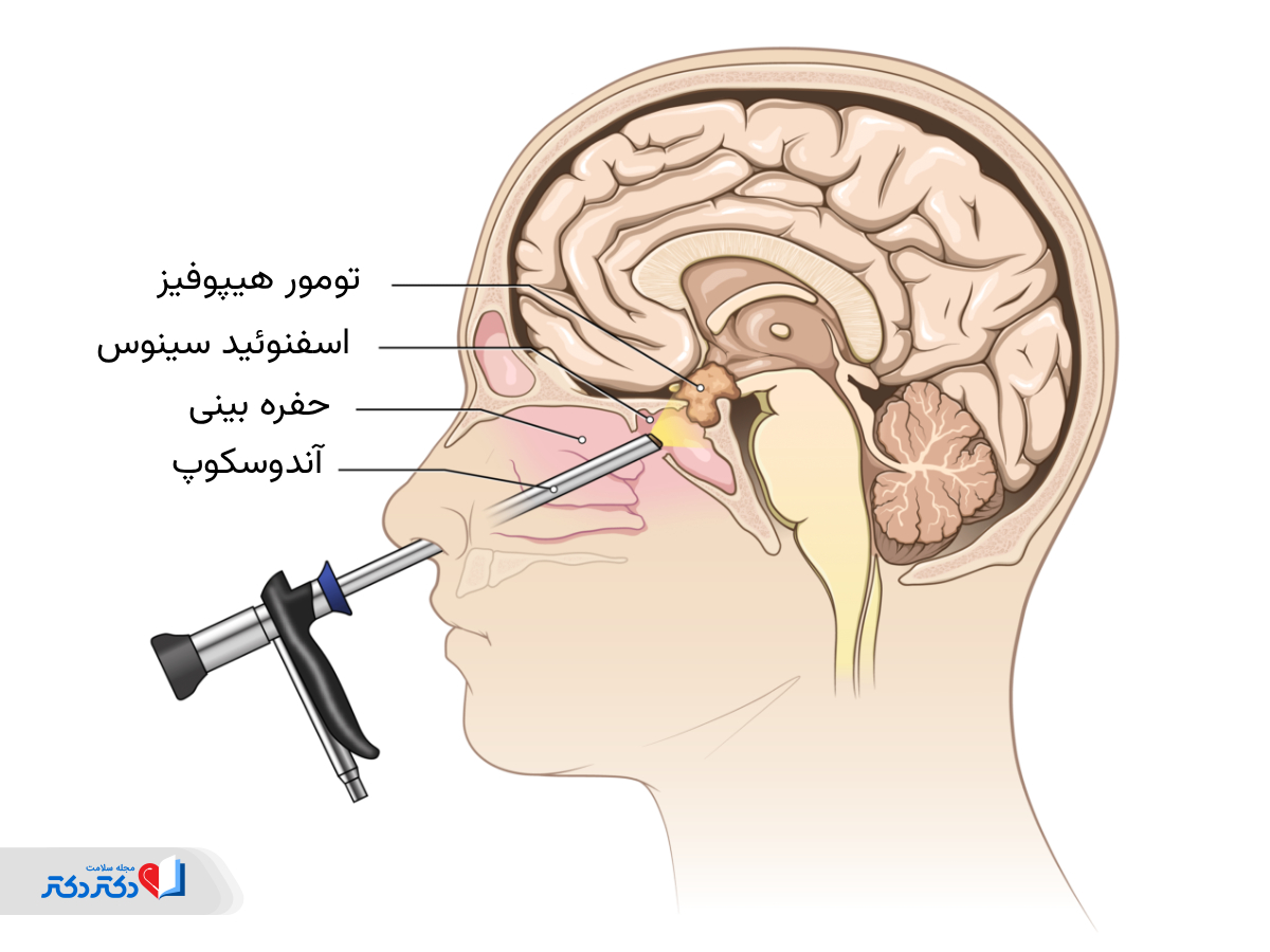جراحی تومور از راه بینی غده هیپوفیز چیست؟