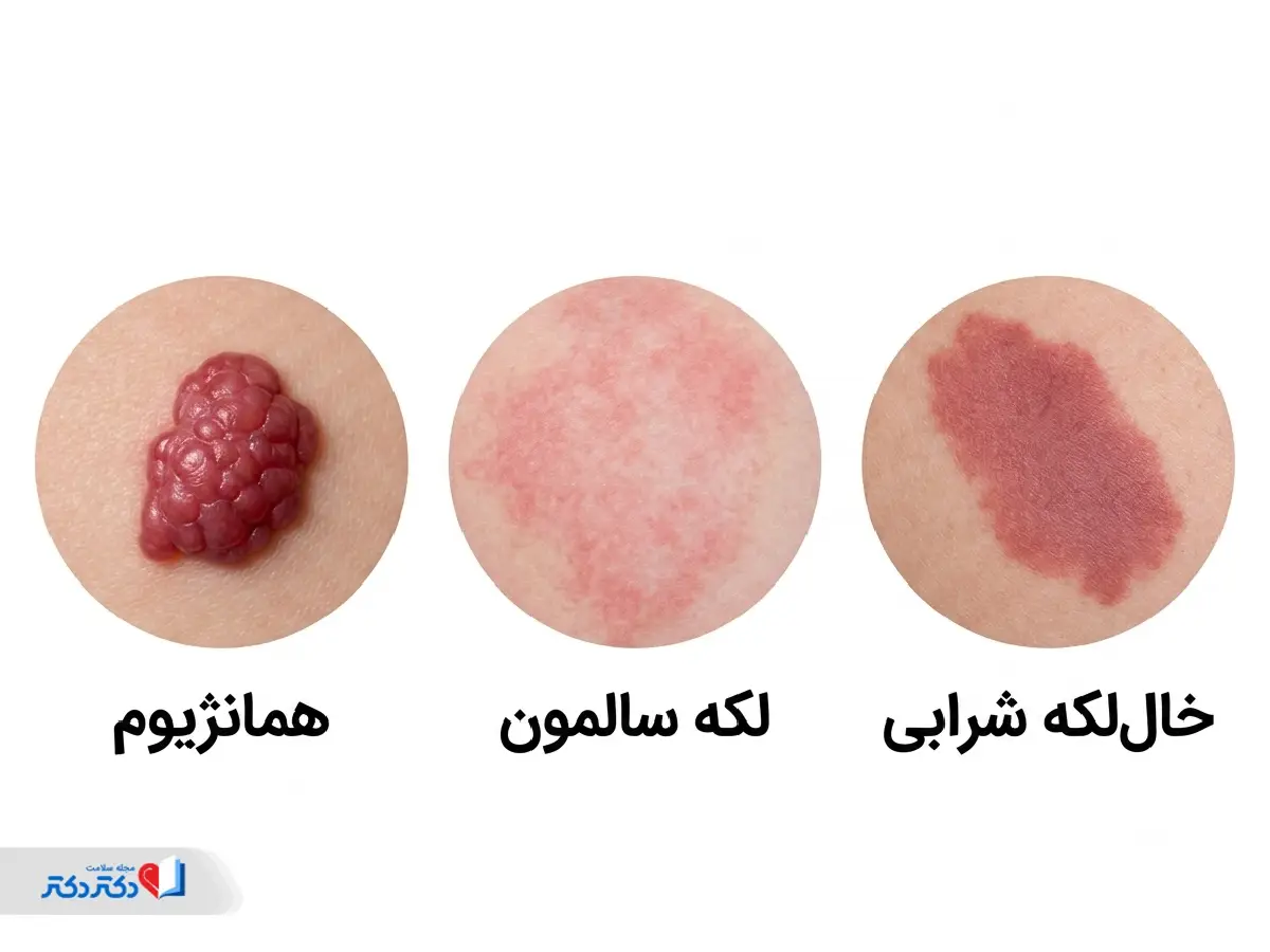 انواع لک مادرزادی در تشخیص لک صورت