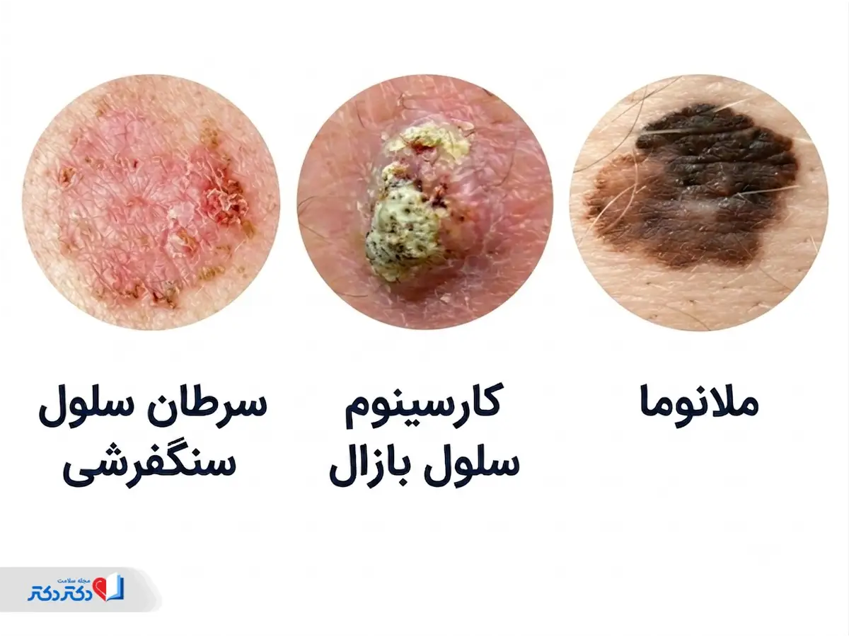 انواع سرطان پوست در تشخیص لک صورت