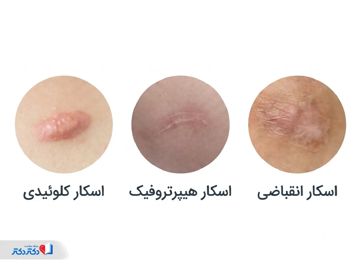 انواع اسکار یا جای زخم در تشخیص لک صورت