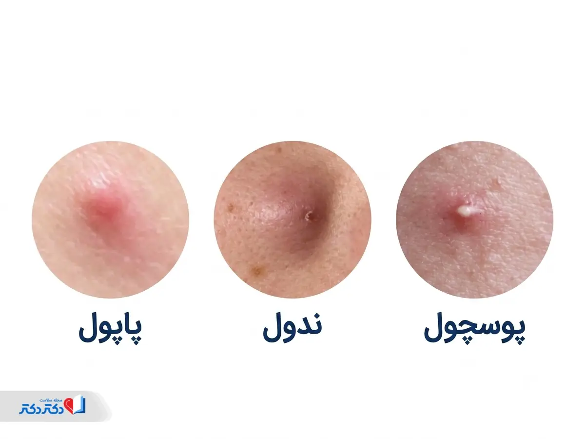 انواع لک صورت شامل پاپول، ندول و پوسچول