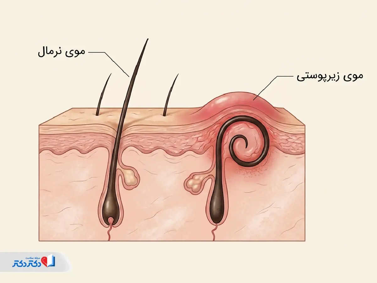موی زیرپوستی از عوامل لک صورت