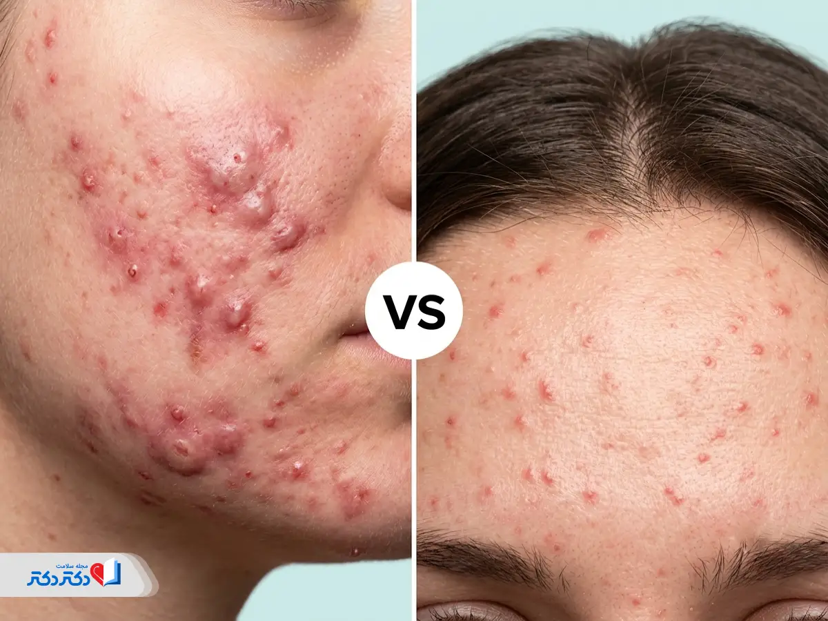 عکس جوش قارچی صورت با آکنه هورمونی