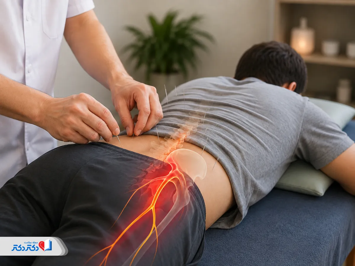 طب سوزنی برای سیاتیک | نکات مهم درباره درمان، عوارض و هزینه این روش