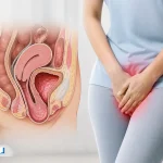 افتادگی مثانه در زنان و مردان چیست؟ بررسی علائم، دلایل و درمان