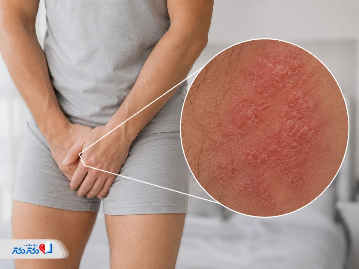 اگزمای تناسلی چیست و چرا ایجاد می‌شود؟ هرآنچه درباره درمان آن باید بدانید