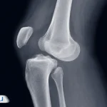 همه‌چیز درباره دررفتگی زانو؛ از علائم اولیه تا طول درمان و مراقبت‌ها