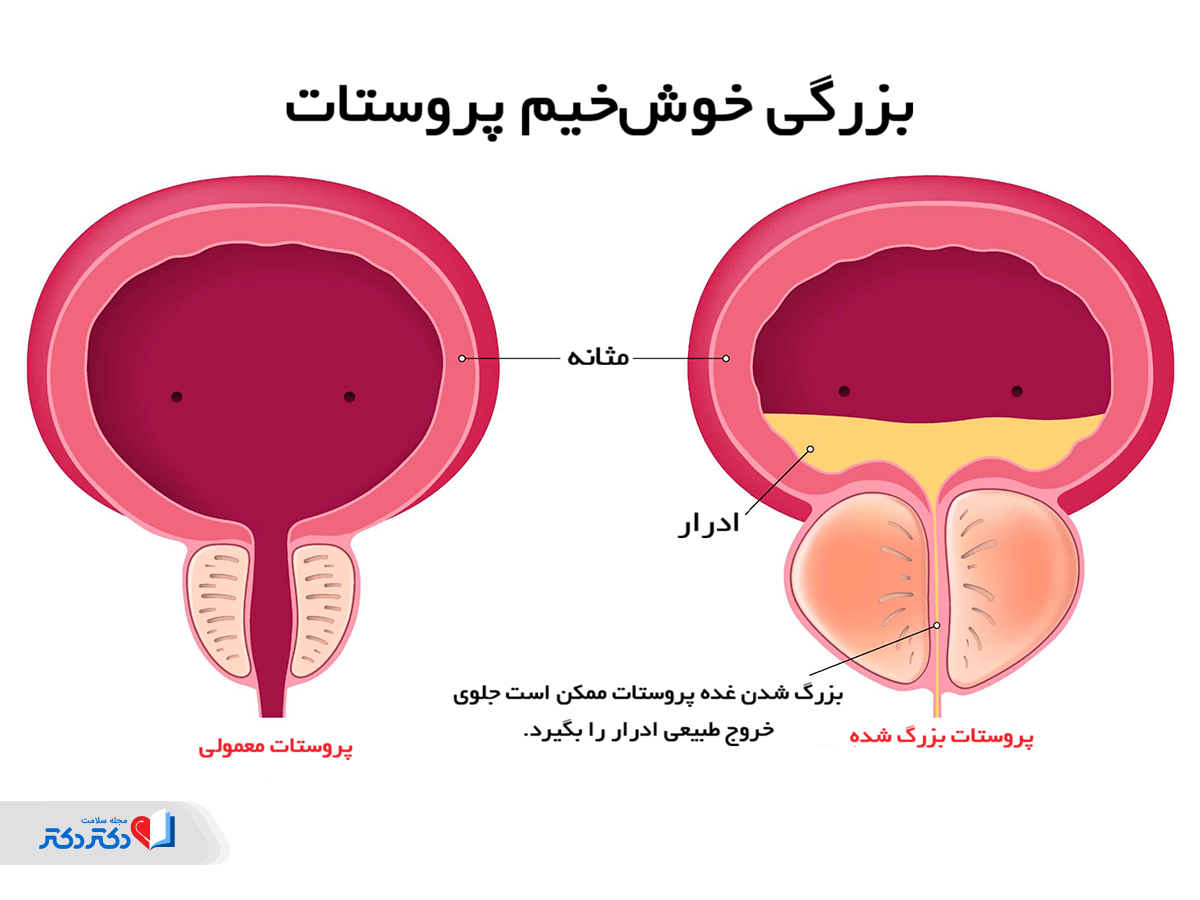 انسداد مسیر خروج ادرار
