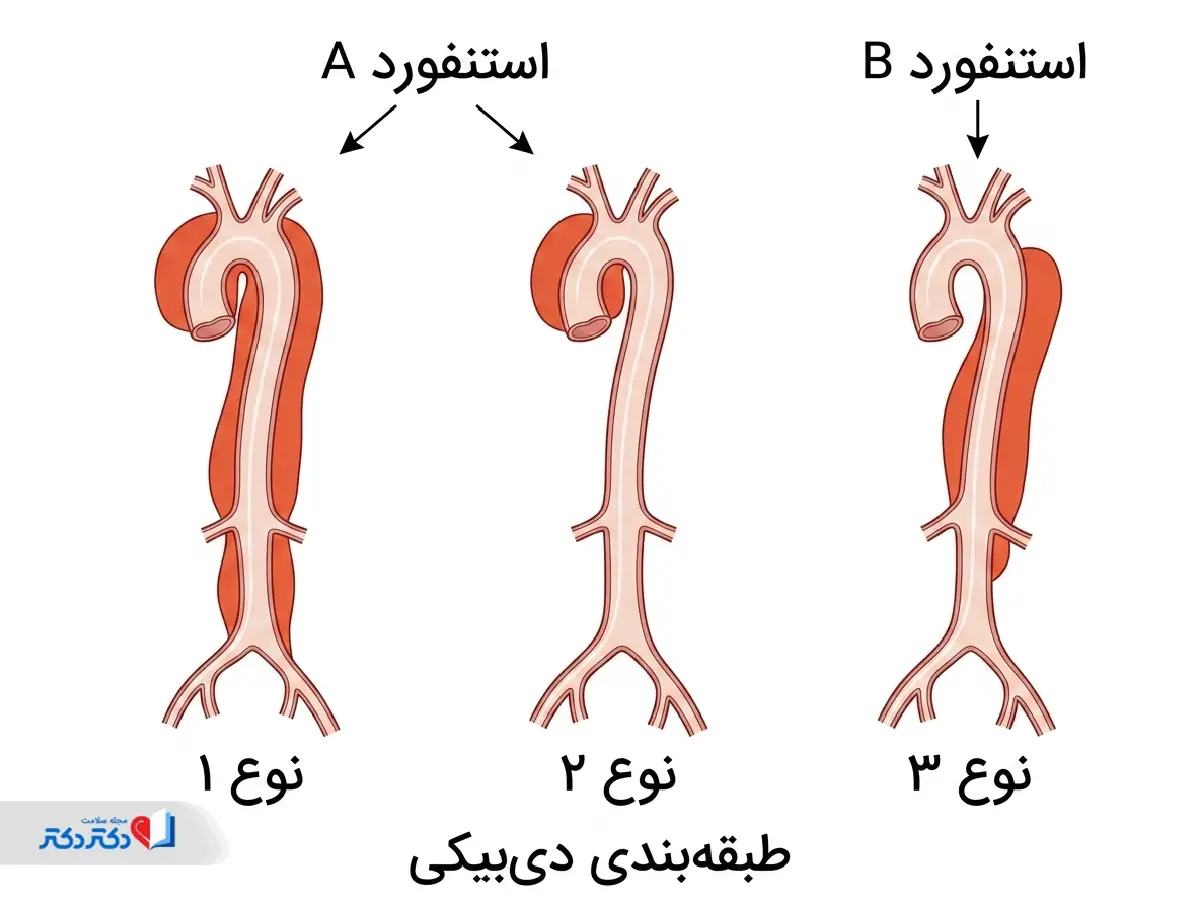 انواع دایسکشن آئورت