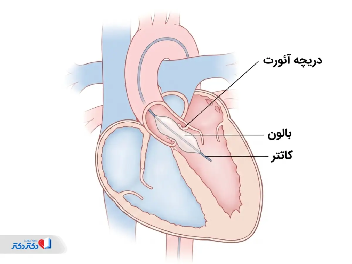 والولوپلاستی برای درمان بیماری دریچه آئورت قلب