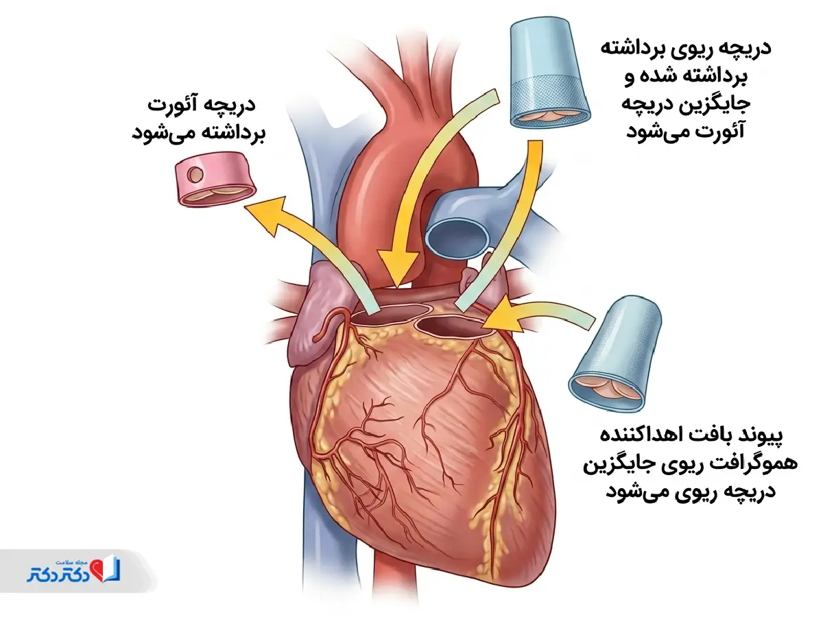 عمل راس برای درمان بیماری دریچه آئورت قلب