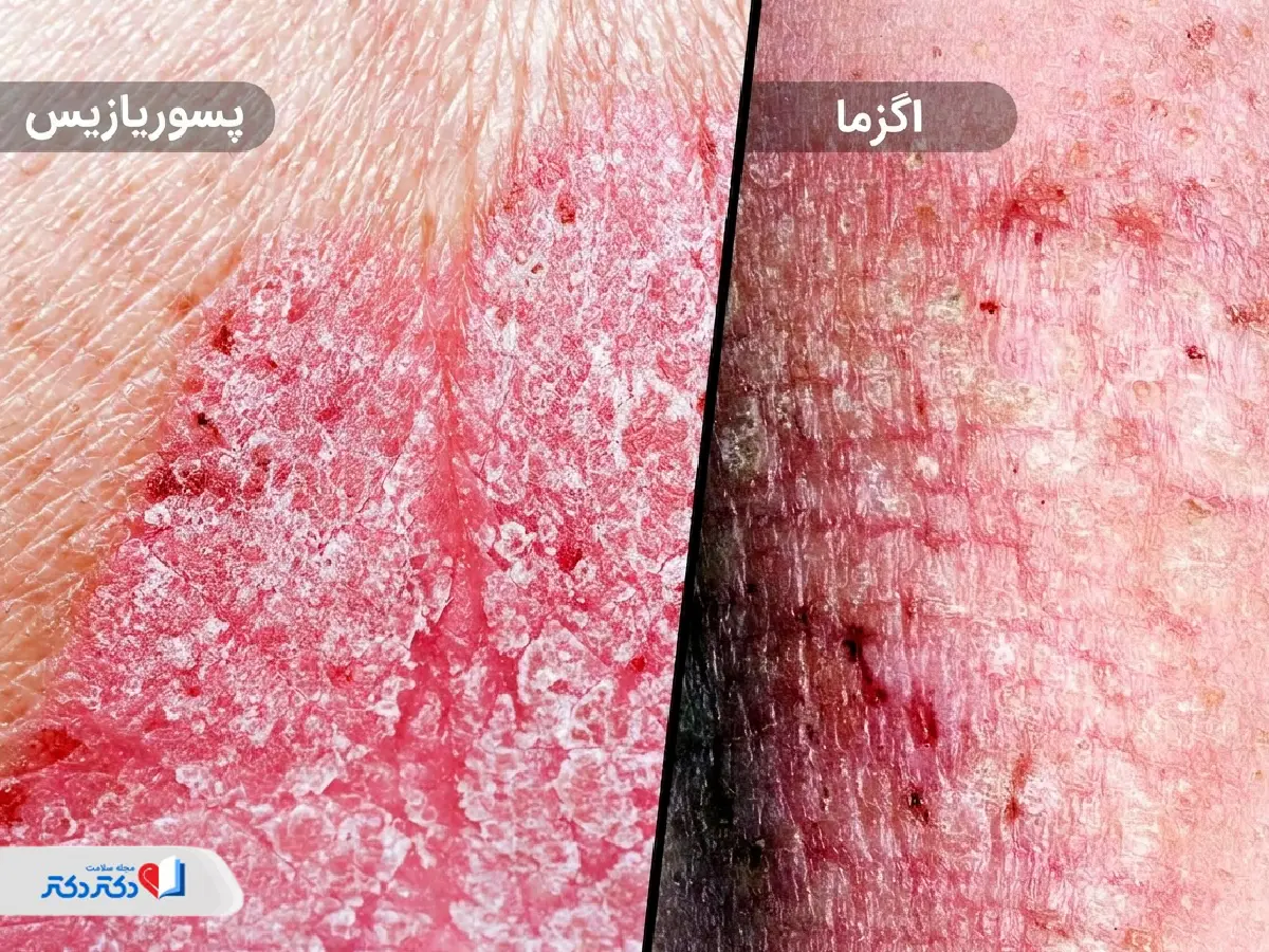 تفاوت درماتیت آتوپیک و پسوریازیس چیست؟