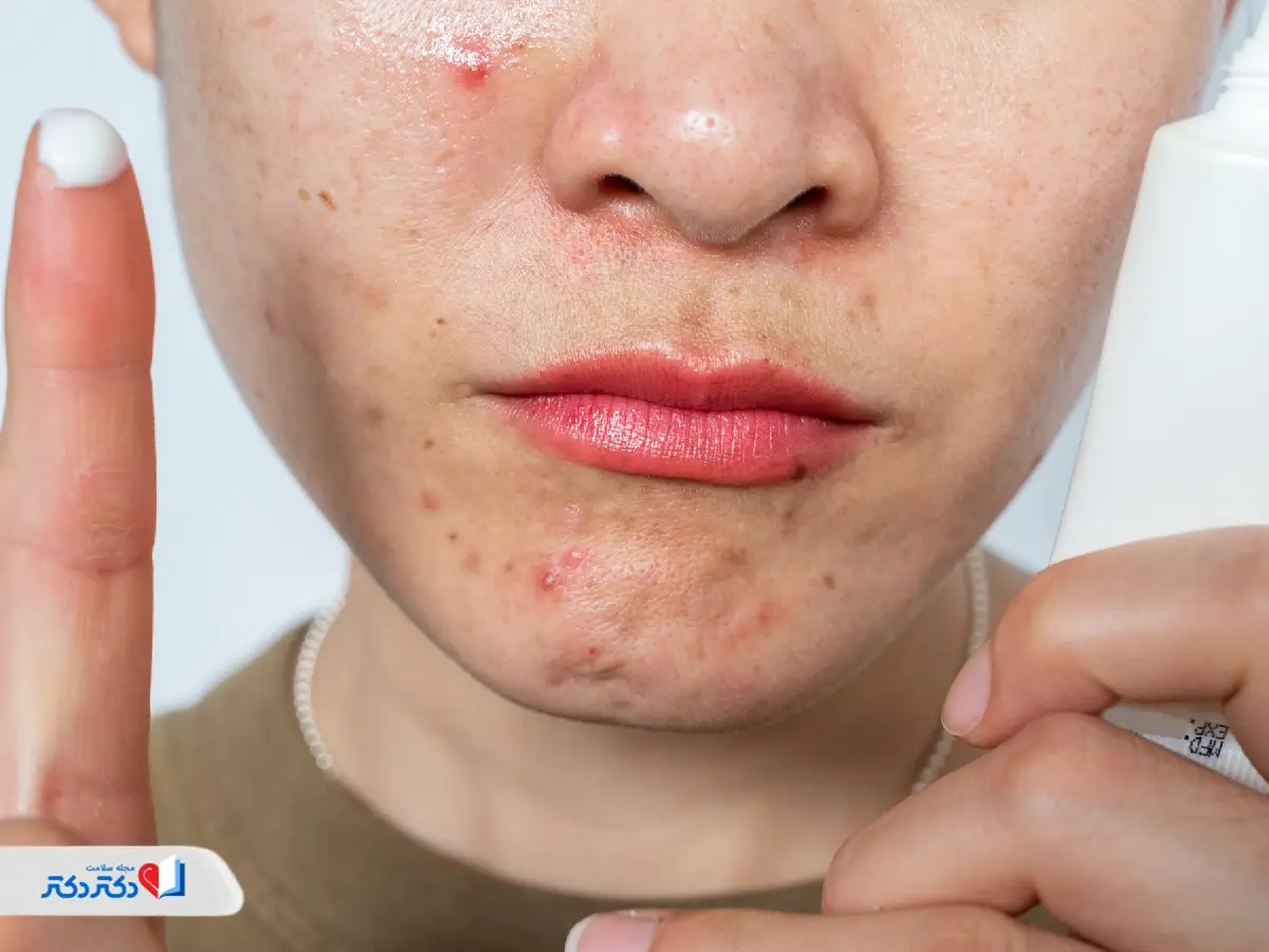 چطور بهترین پماد برای جوش صورت را انتخاب کنیم؟