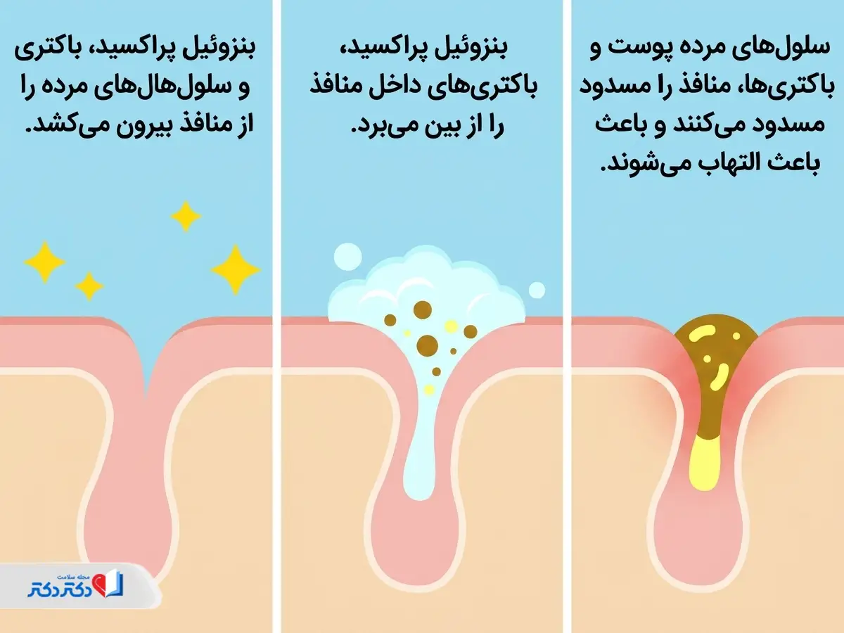 نحوه عملکرد بنزوئیل پراکسید برای ازبینبردن جوش