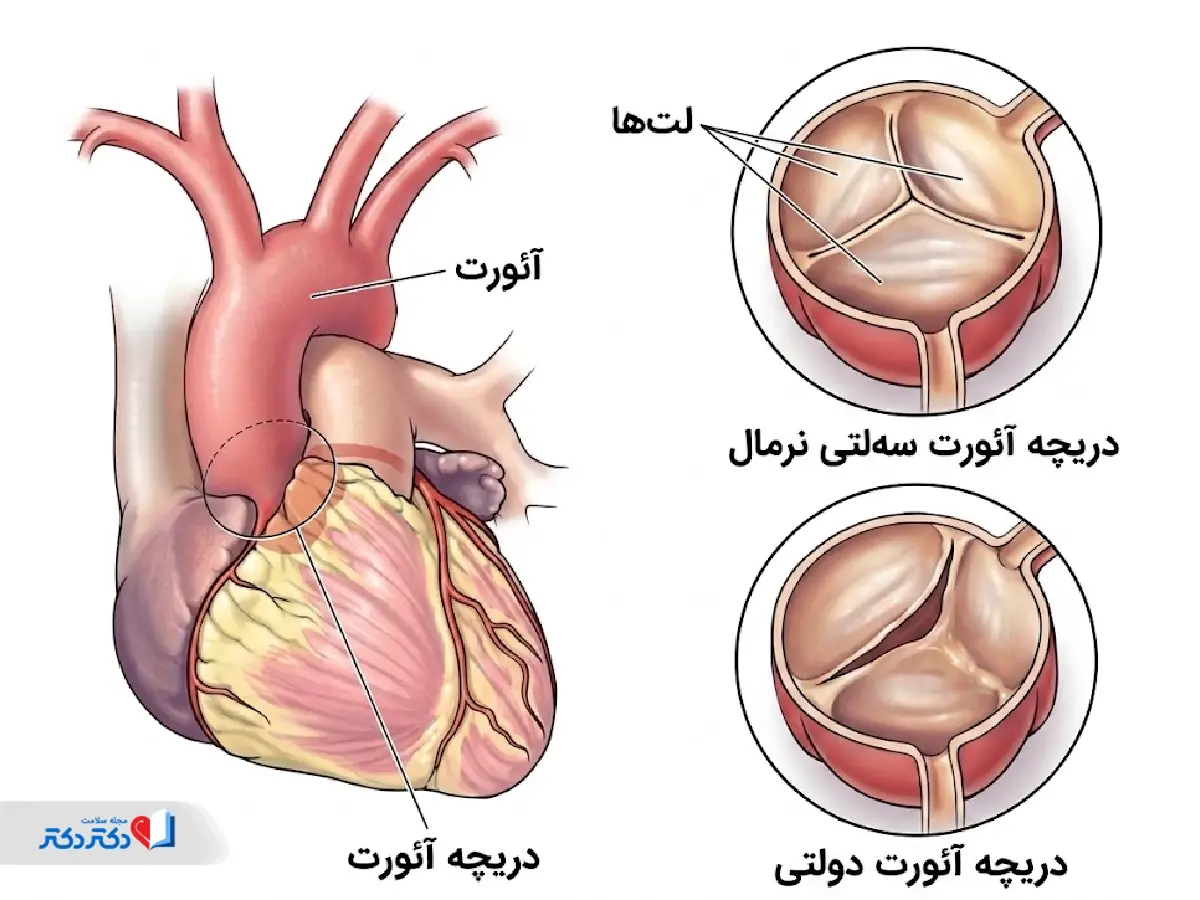 تفاوت دریچه آئورت دولتی و سهلتی