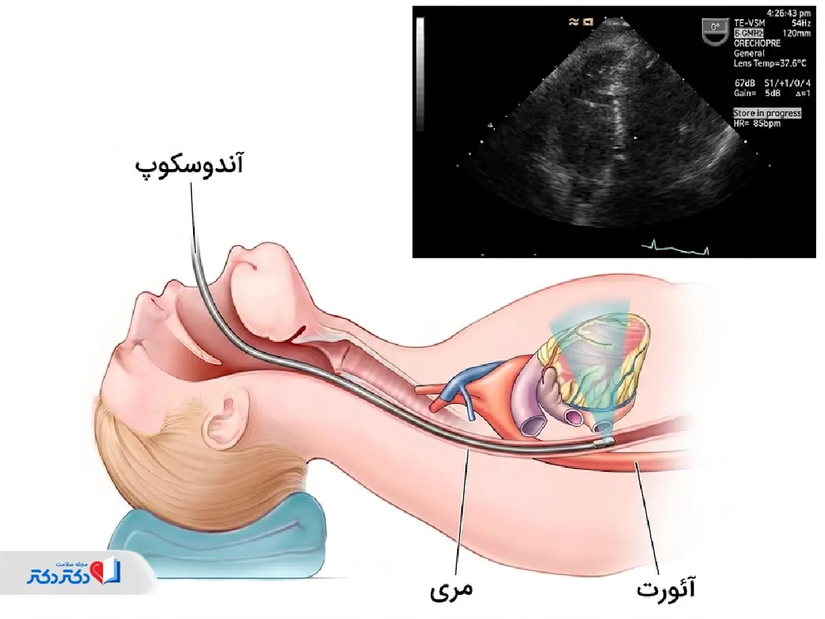 اکوکاردیوگرافی از طریق مری (TTE)