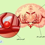 همه‌چیز درباره آنوریسم مغزی؛ علت، علائم، تشخیص و مراقبت‌های لازم