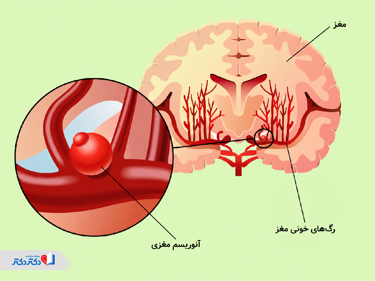 همهچیز درباره آنوریسم مغزی؛ علت، علائم، تشخیص و مراقبتهای لازم
