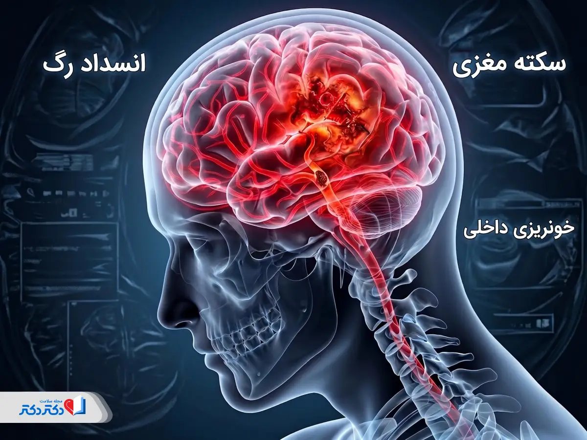 تنگی و گرفتگی رگ‌های مغز چه علائمی دارد و چگونه درمان می‌شود؟