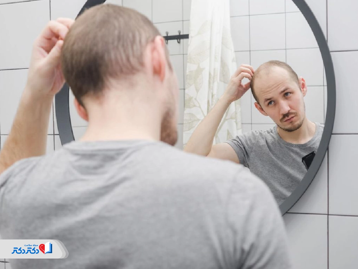 ریزش موی هورمونی
