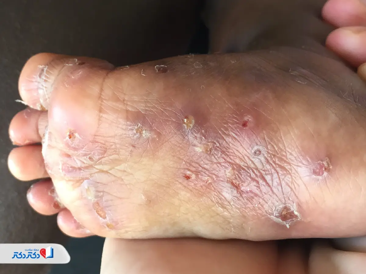 خارش کف پا ناشی از گال