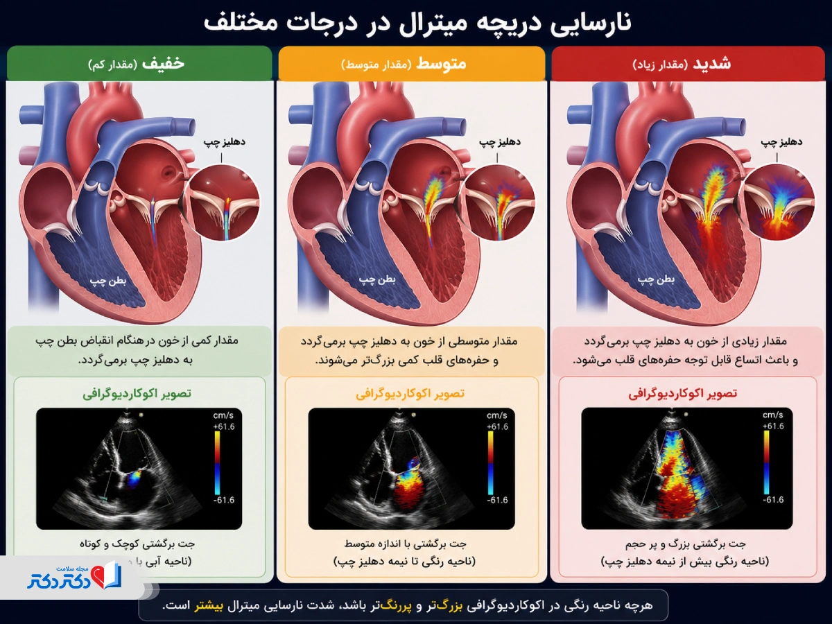 انواع نارسایی دریچه میترال