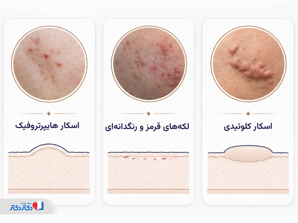 اسکارهای نامناسب برای انجام سابسیژن