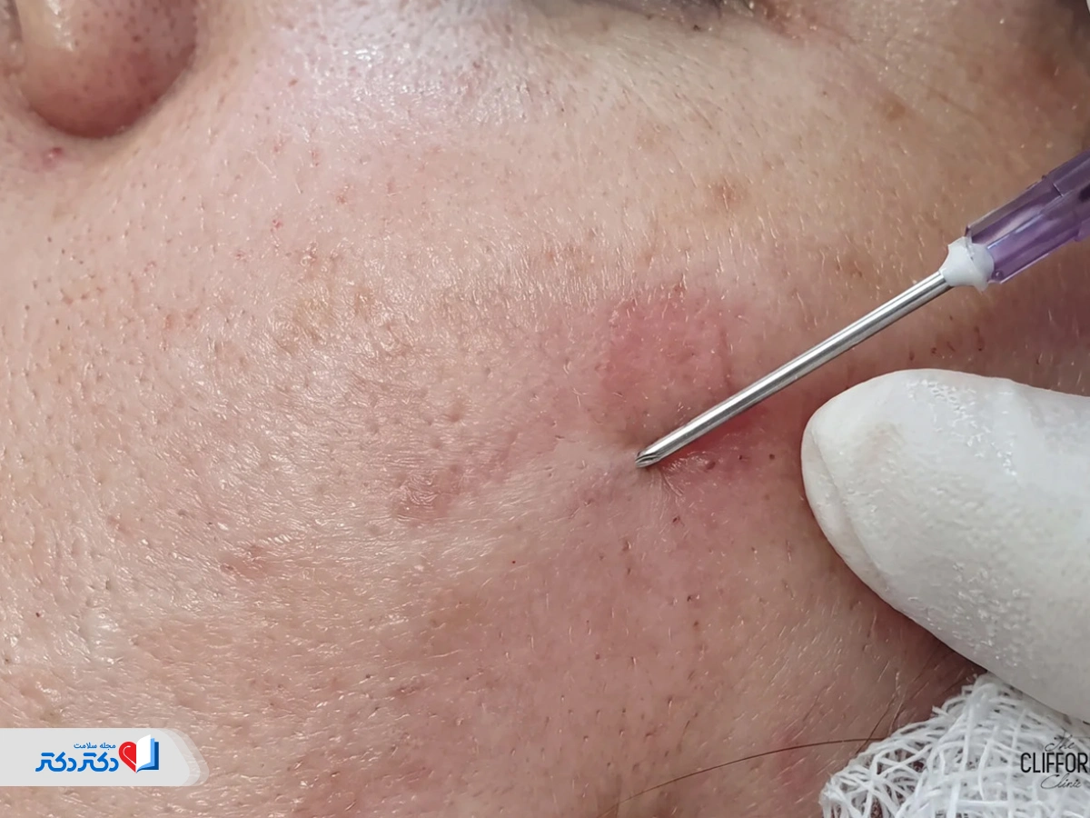 عوارض سابسیژن
