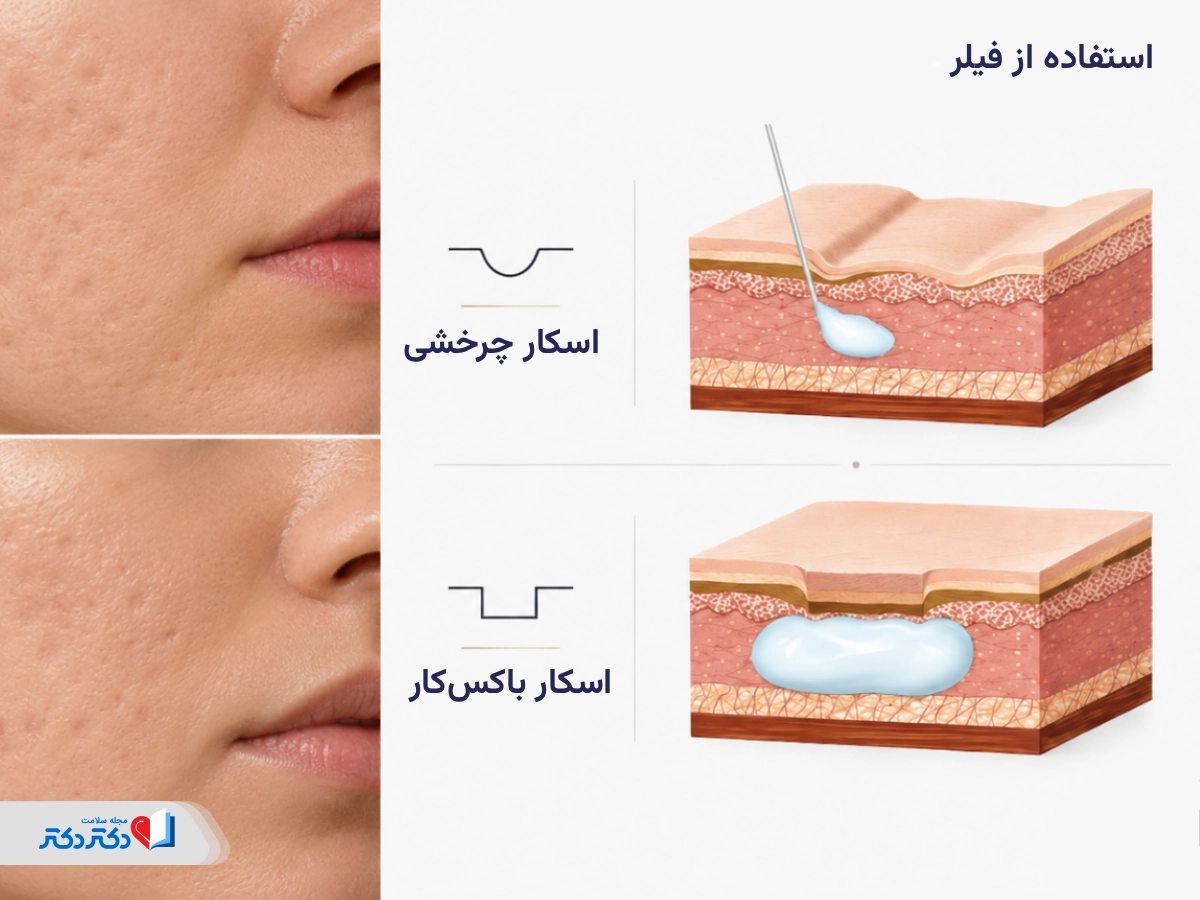 انجام فیلر پس از سابسیژن