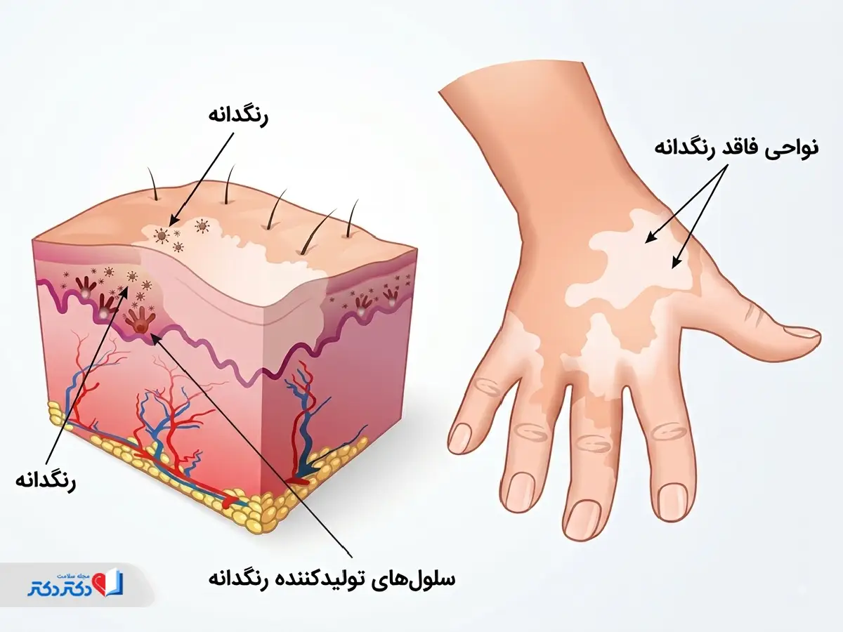 علت ایجاد پیسی