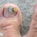 علت قارچ ناخن چیست و چگونه از آن جلوگیری کنیم؟