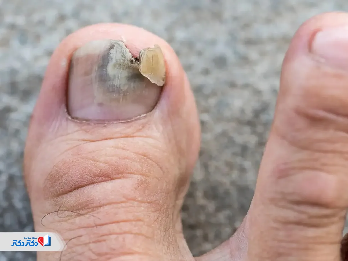 علت قارچ ناخن چیست و چگونه از آن جلوگیری کنیم؟