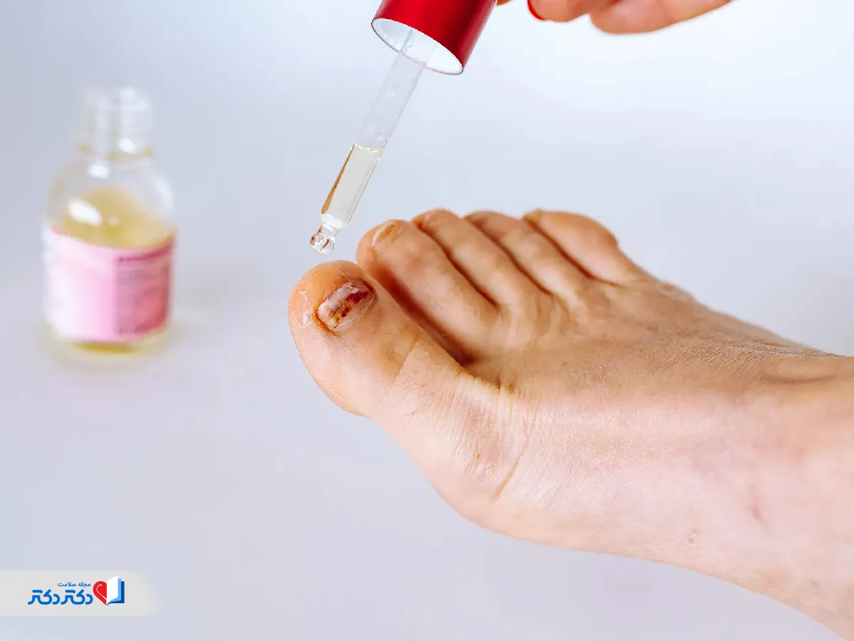 قطره قارچ ناخن