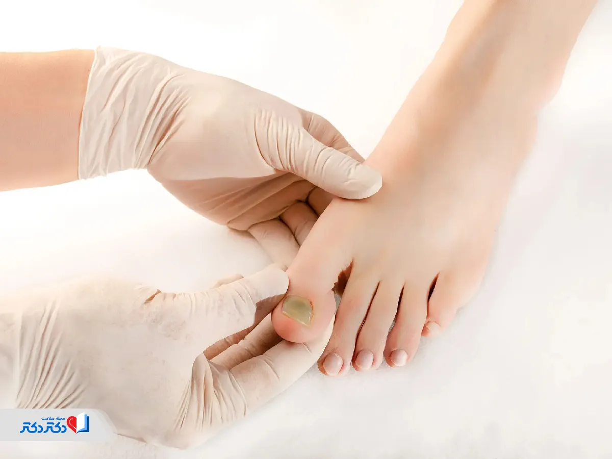 بررسی پا برای وجود قارچ ناخن در افراد دیابتی