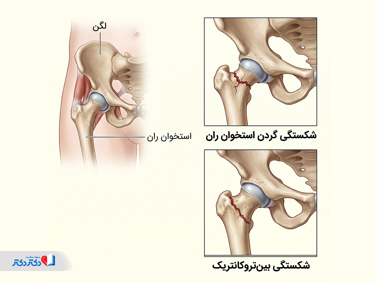 انواع شکستگی لگن