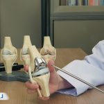 تعویض مفصل چیست و چه زمانی انجام می‌شود؟ راهنمای کامل و دوران نقاهت