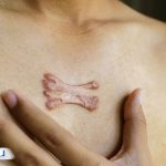 راهنمای کامل کلوئید؛ علت، تشخیص و درمان گوشت اضافه