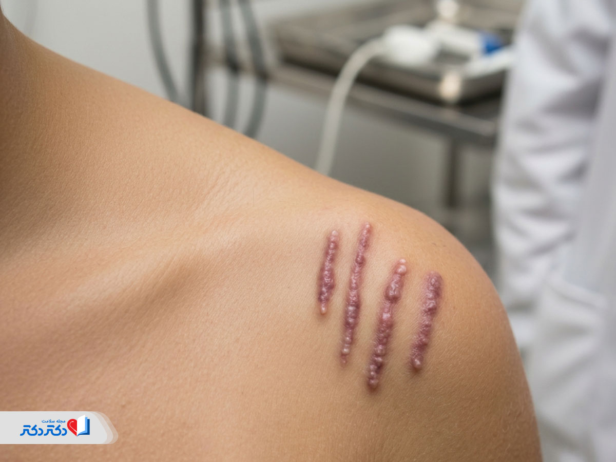 اسکار کلوئید چطور تشخیص داده میشود؟