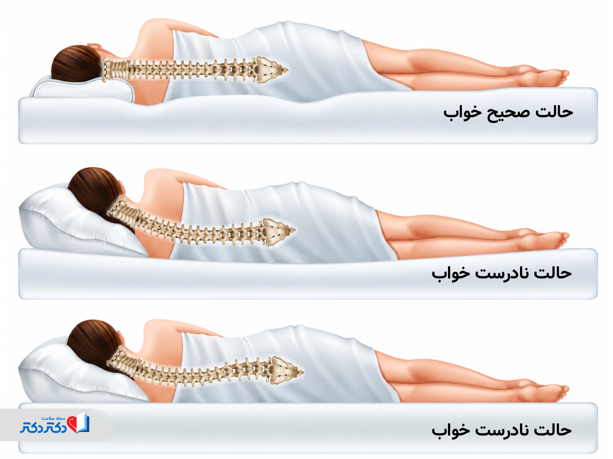 پیشگیری از دیسک کمر چگونه است؟