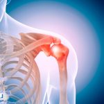 التهاب تاندون شانه چگونه ایجاد می‌شود و راه درمان چیست؟