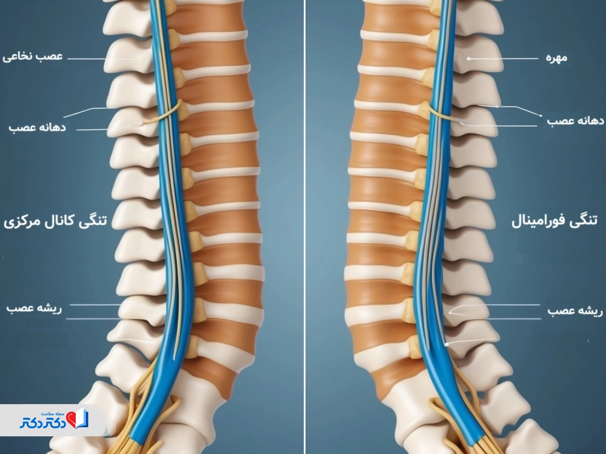 انواع تنگی کانال نخاعی