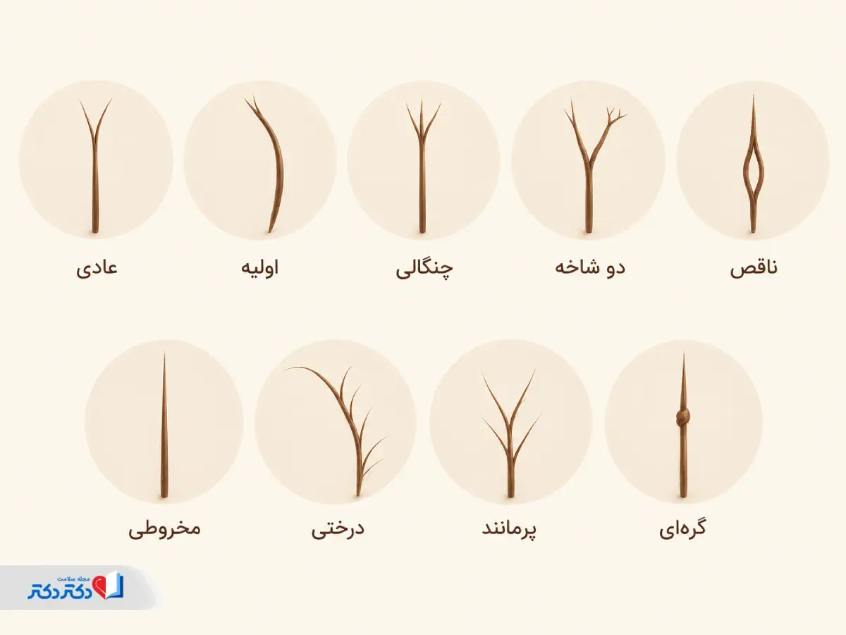 انواع موخوره