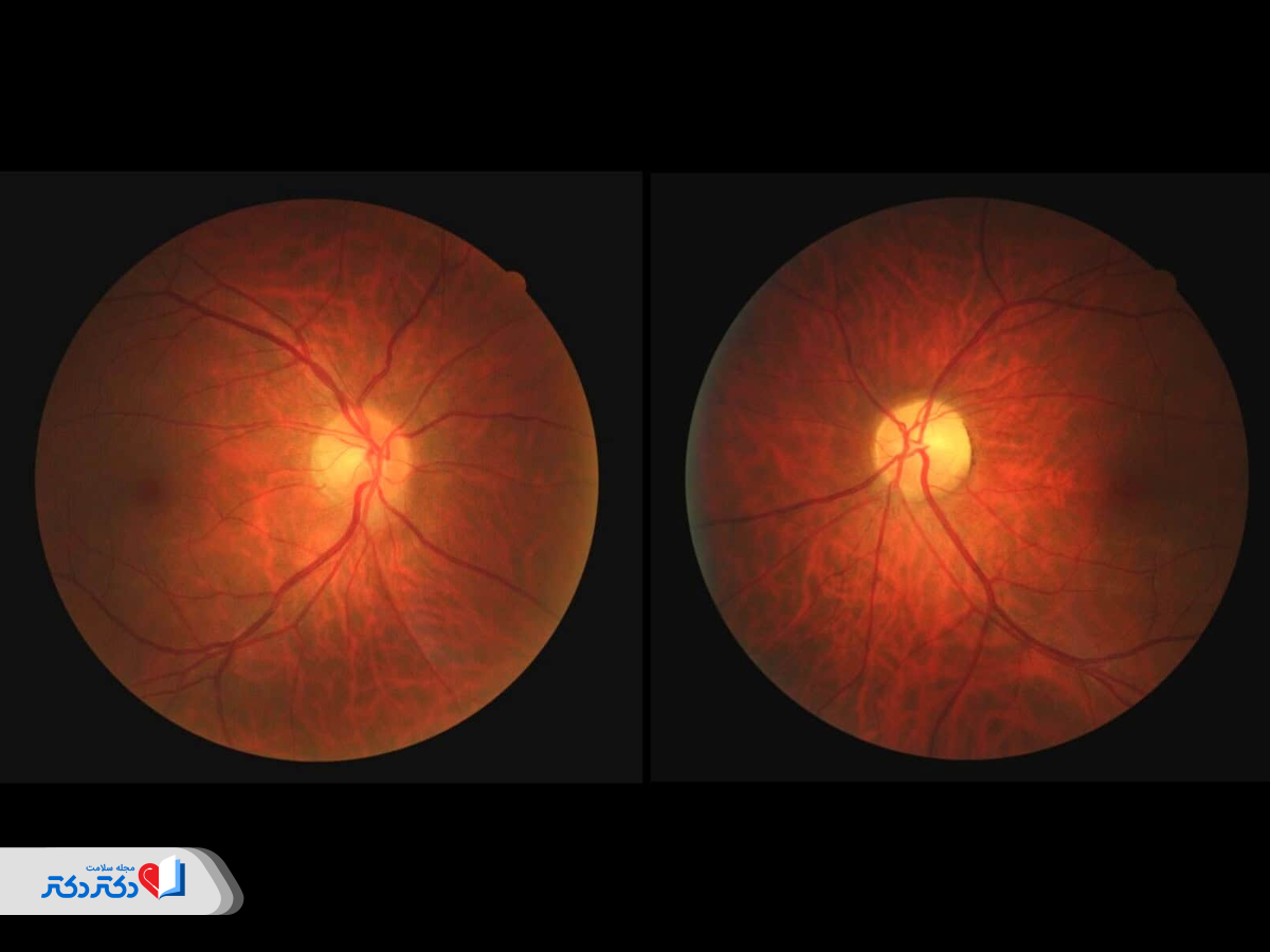 آمپول لاغری و آسیب عصب بینایی