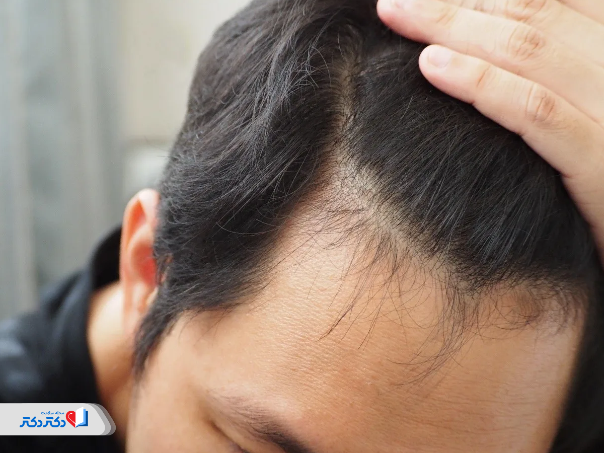 ارتباط ریزش مو با آمپول های لاغری